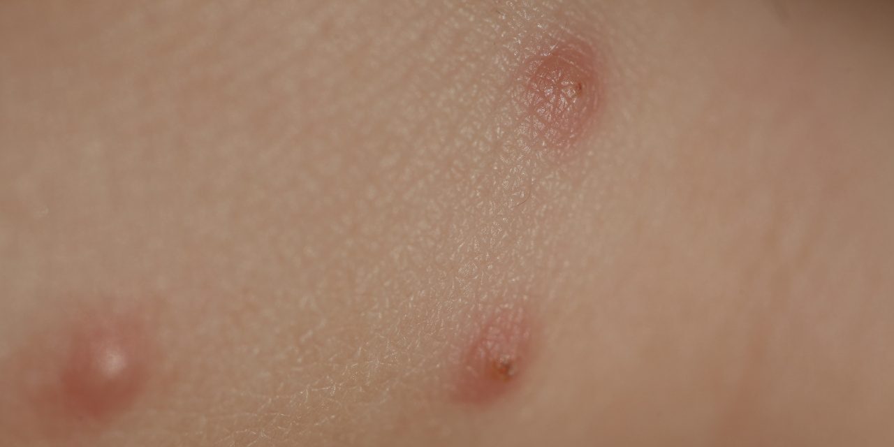 Bed Bug
